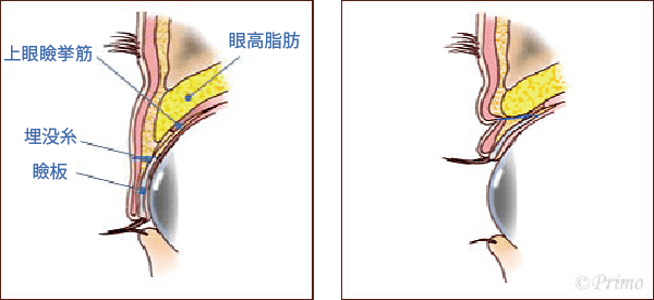 埋没法イラスト